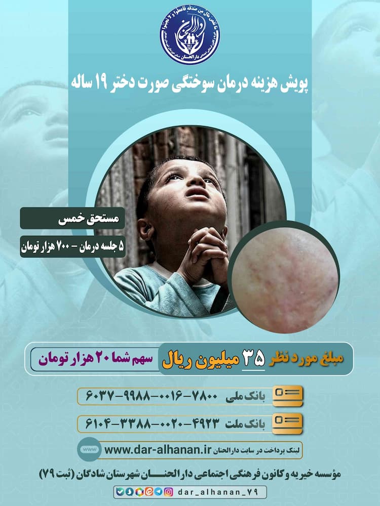 درمان سوختگی صورت دختر ۱۹ ساله موسسه خیریه دارلحنان 